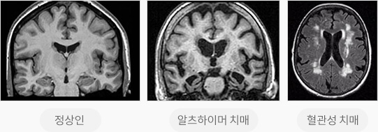 뇌 자기공명 영상